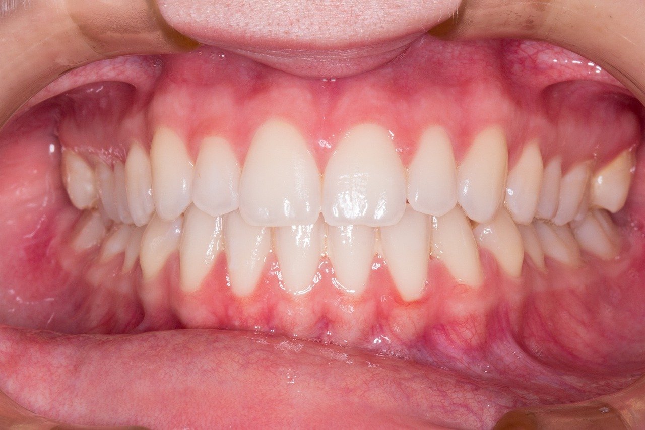 Invisalign Comprehensive (18 meses)